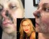 “Nose flesh dripping”… What happened to the American woman whose face rotted after receiving injections?